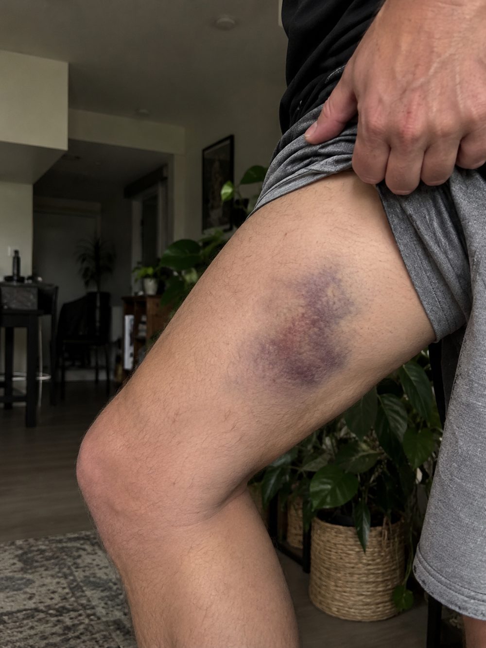 Bruise on a goalie's thigh